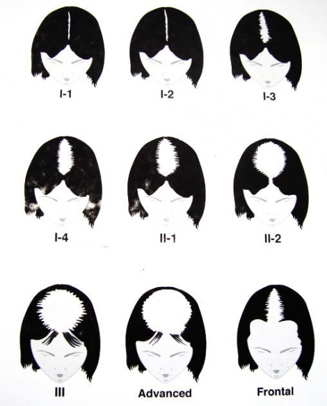 female_pattern_Baldness_group