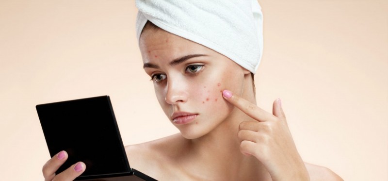 How-To-Get-Rid-Of-Pimples