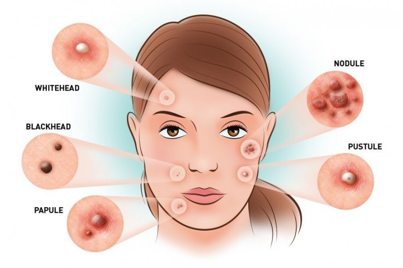 header-types-of-acne-886x590