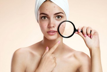 S.O.S Acnee: cum identifici ce tip de acnee ai